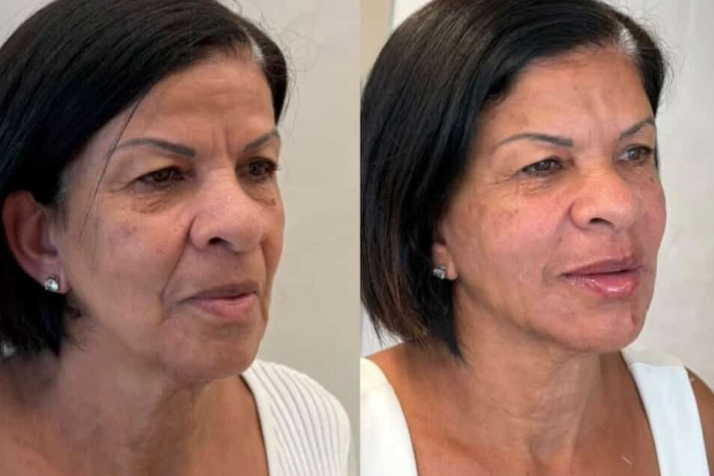 Antes e depois · Facial · Vivency