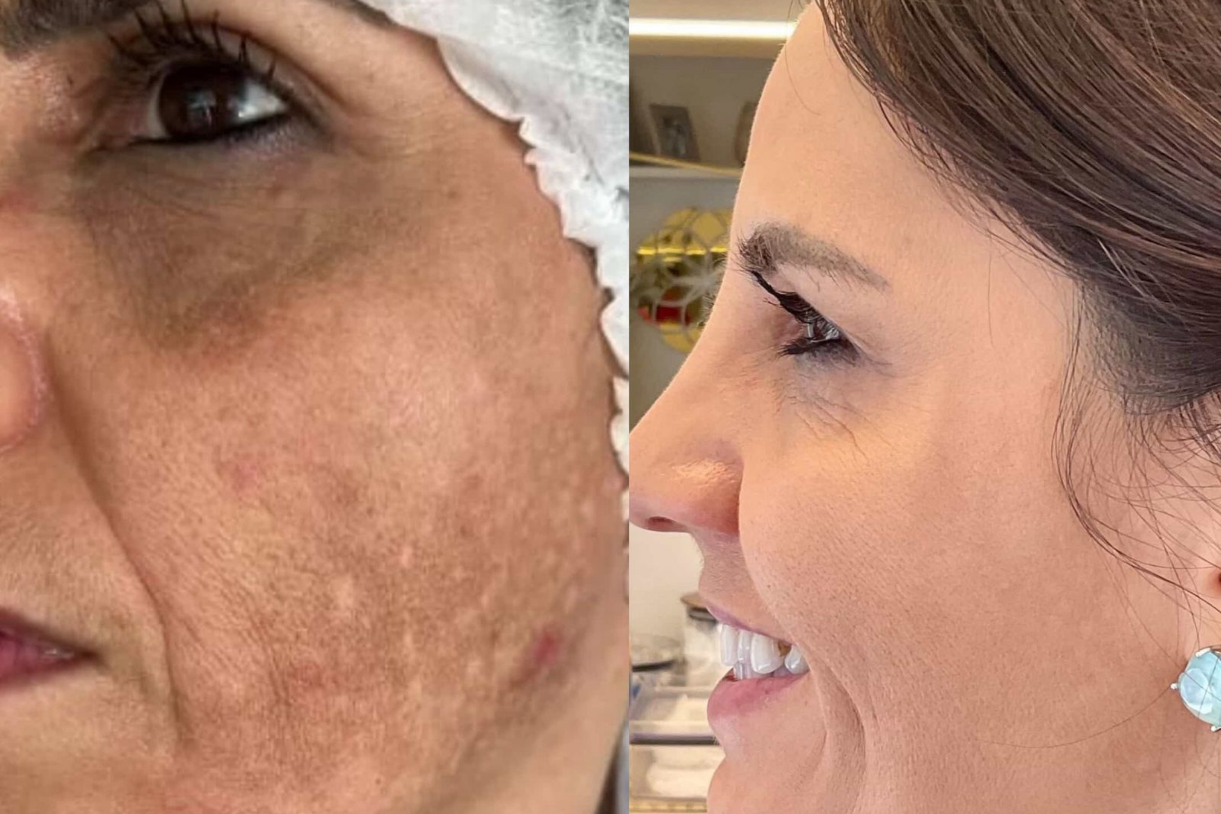 Antes e depois · Facial · Vivency