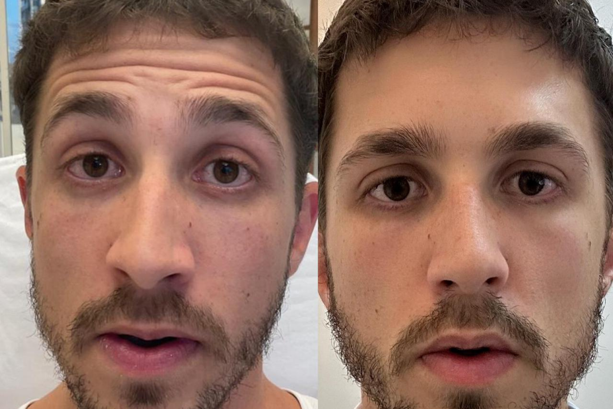 Antes e depois · Facial · Vivency