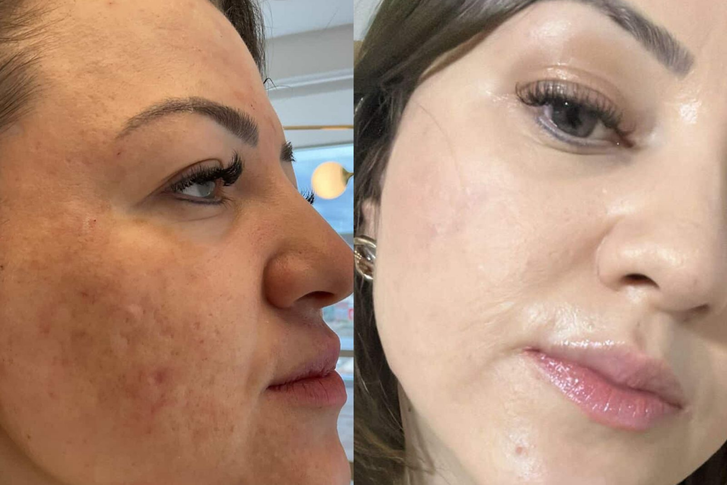 Antes e depois · Facial · Vivency