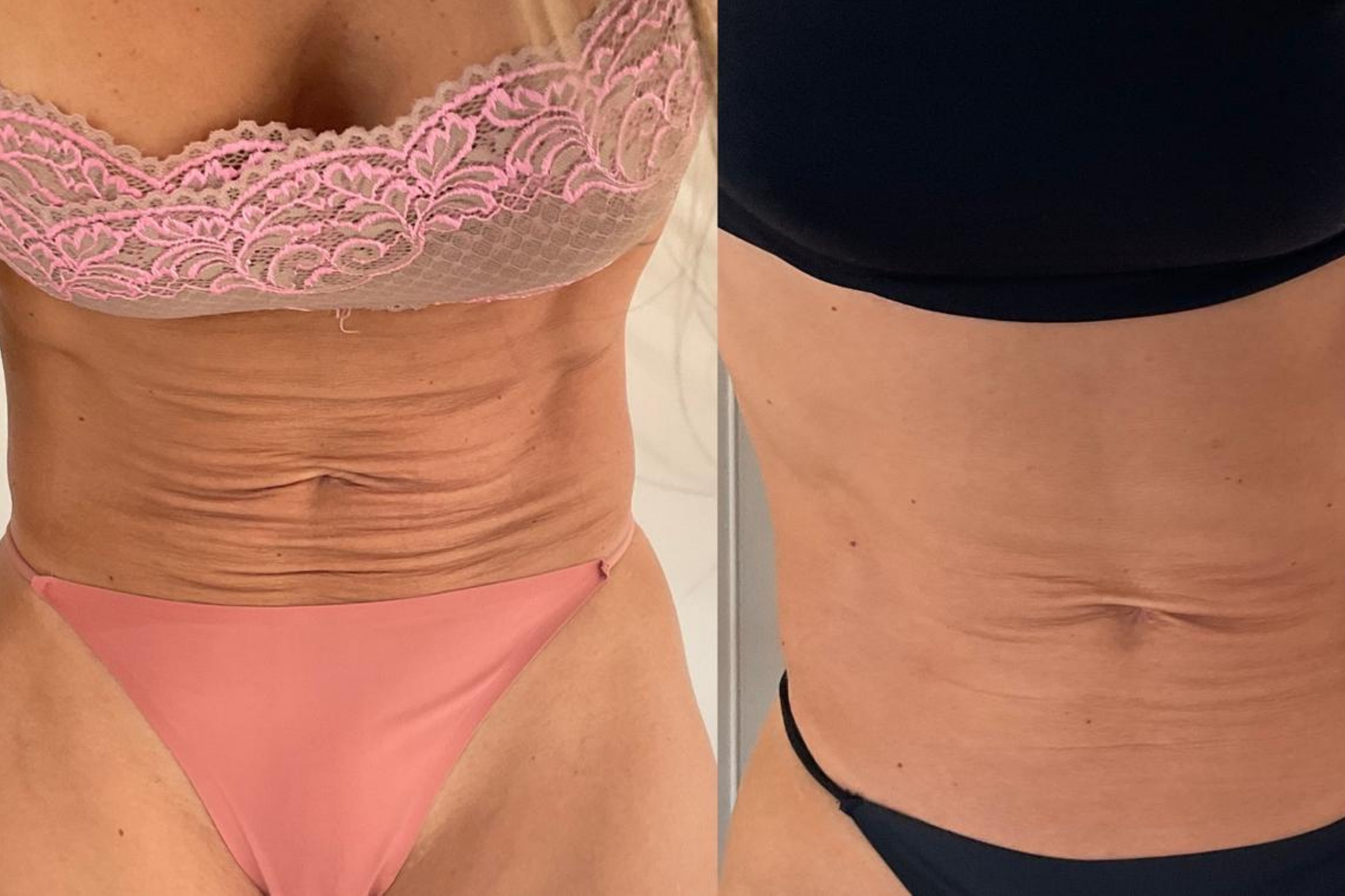 Antes e depois · Corporal · Vivency