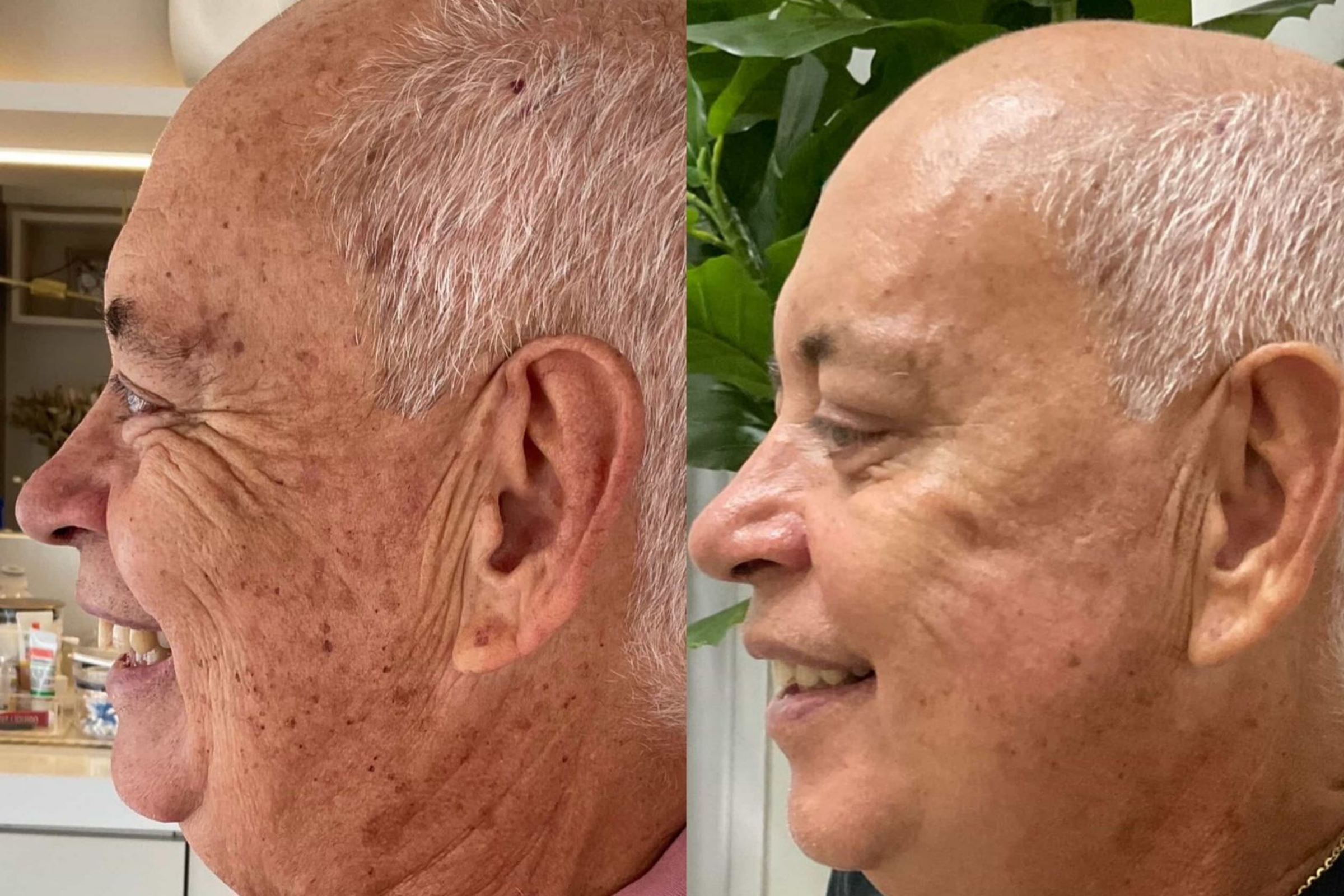 Antes e depois · Facial · Vivency