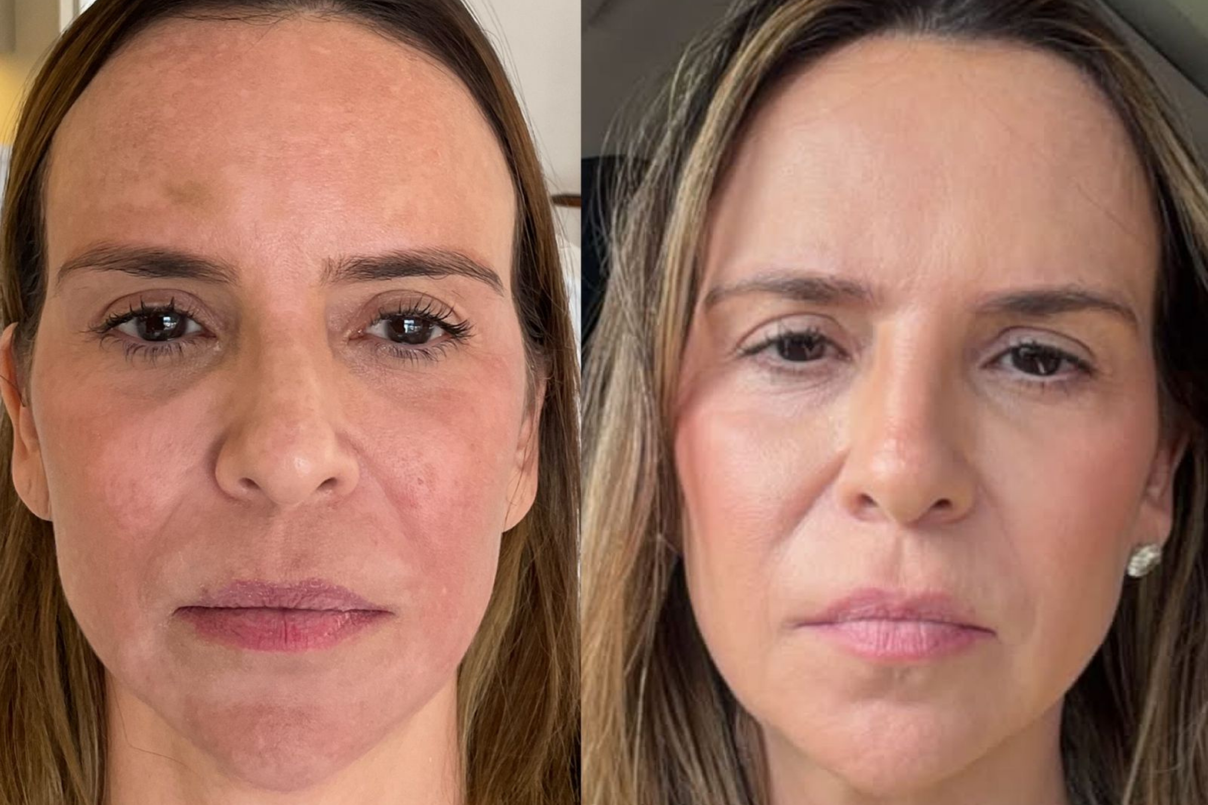 Antes e depois · Facial · Vivency