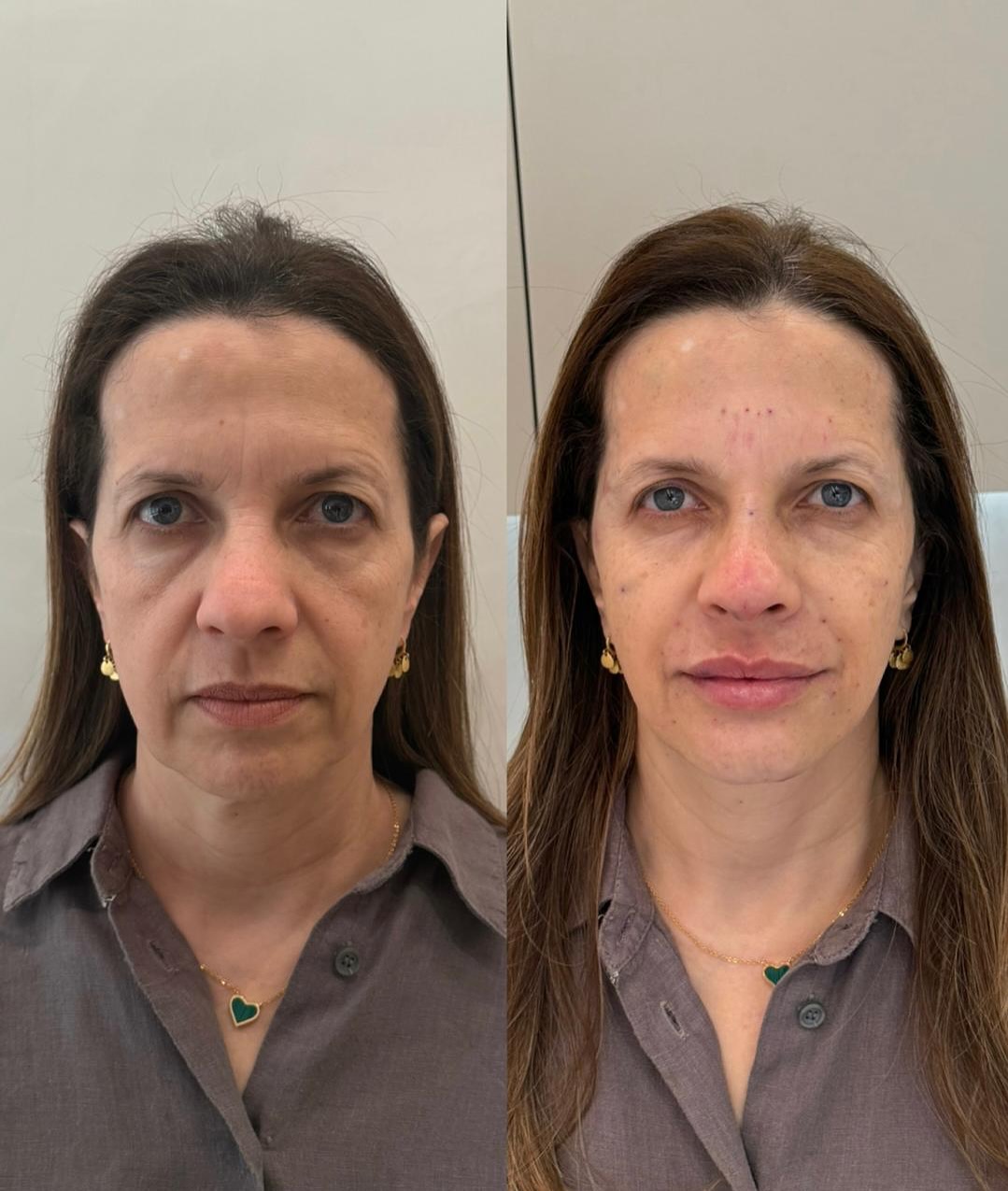 Antes e depois · Vivency
