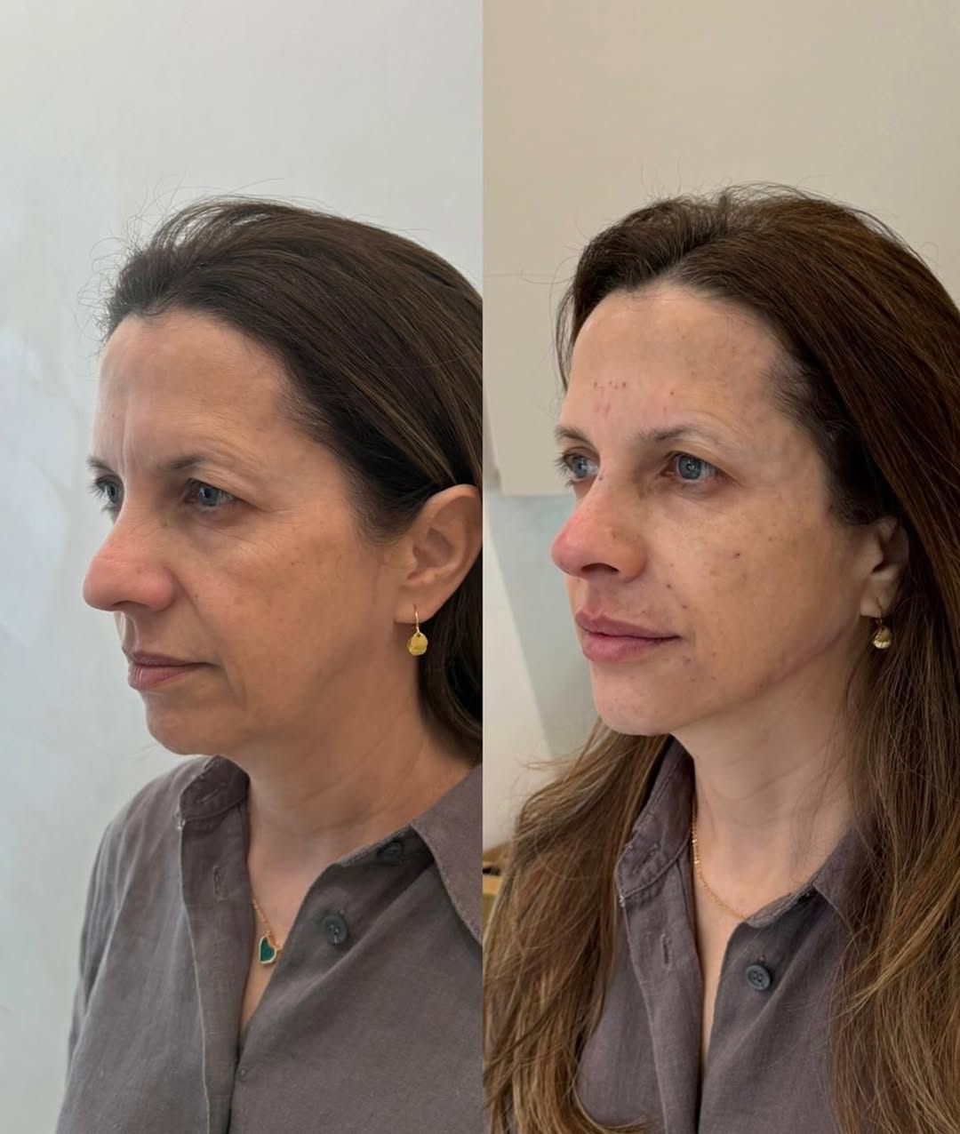Antes e depois · Vivency