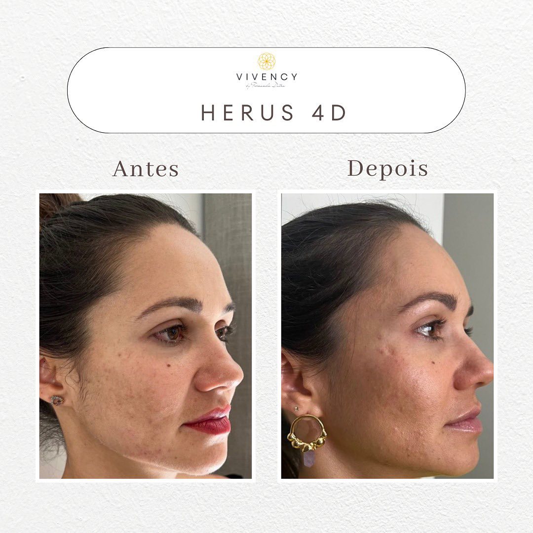 Antes e depois · Vivency